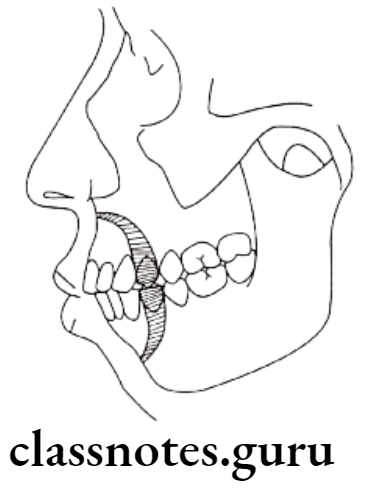 Orthodontics Surgical Orthodontics Bimaxillary protrusion require maxillary and mandibular segmental osteotomy