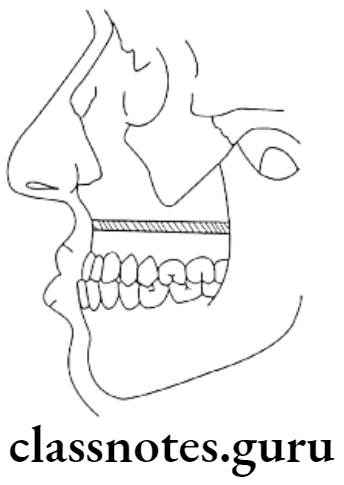 Orthodontics Surgical Orthodontics Class 3 skeletal pattern