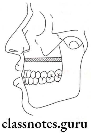 Orthodontics Surgical Orthodontics Long face is usually associated with vertical maxillary