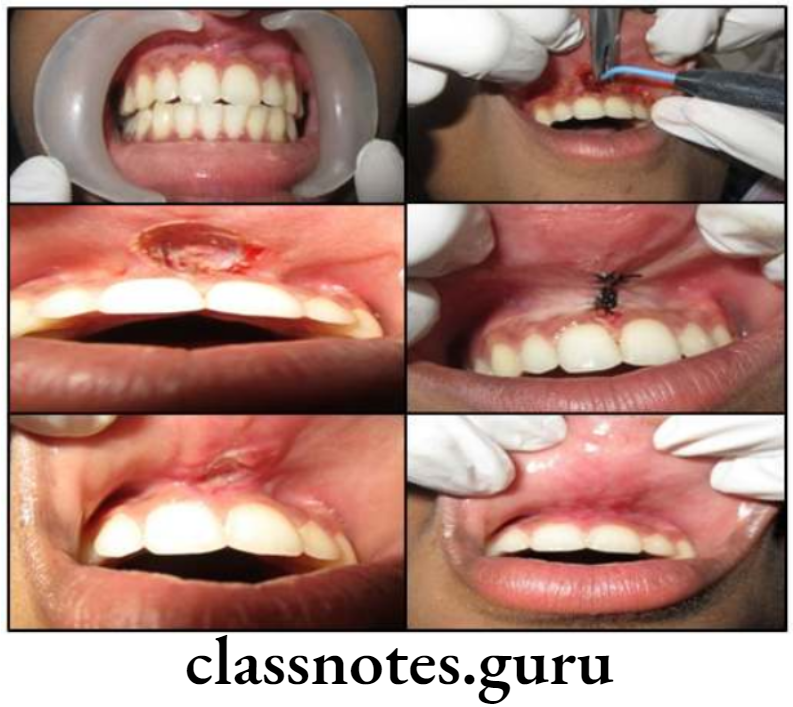 Orthodontics Surgical Orthodontics Maxillary Labial Frectonomy