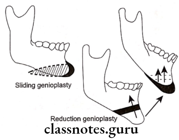Orthodontics Surgical Orthodontics Sliding and reduction genioplasty