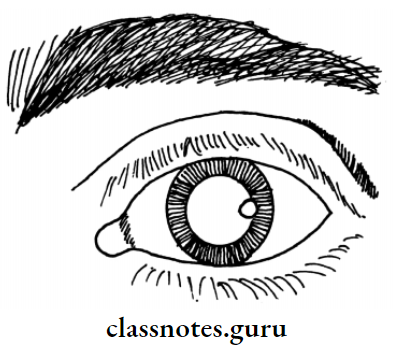 Cataract Cataract In The Eye