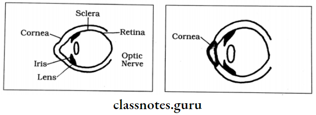 Cataract How To Cataract Is Formed