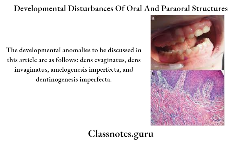 Developmental Disturbances Of Oral And Paraoral Structures.
