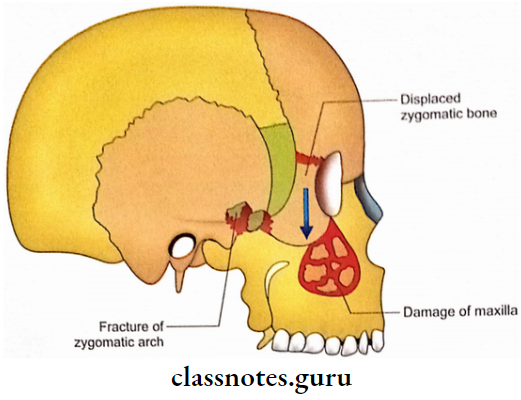 Exterior Of The Skull Depressed Fracture Of Zygomatico-Maxillary Complex