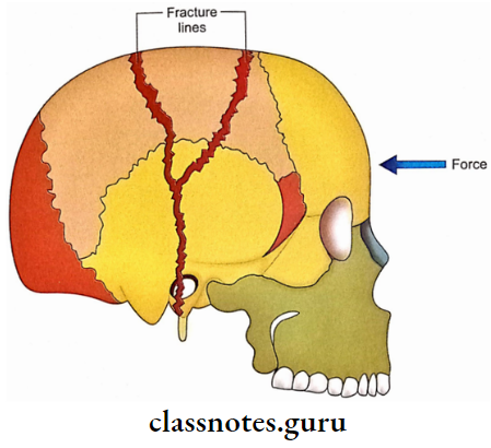 Exterior Of The Skull Ftracture Of Skull Due To Blow On The Forehead