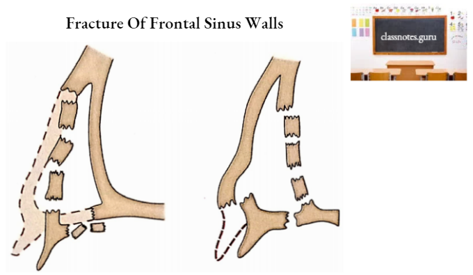 Frontal Bone Fracture Of Frontal Sinus Walls