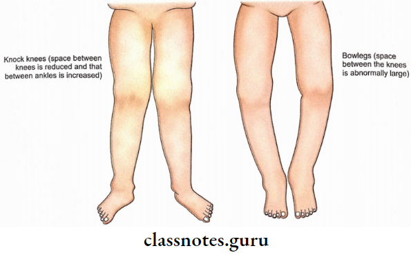 General Considerations Of Bone Deformities Of The Lower Limb In Rickets And Osteomalacia