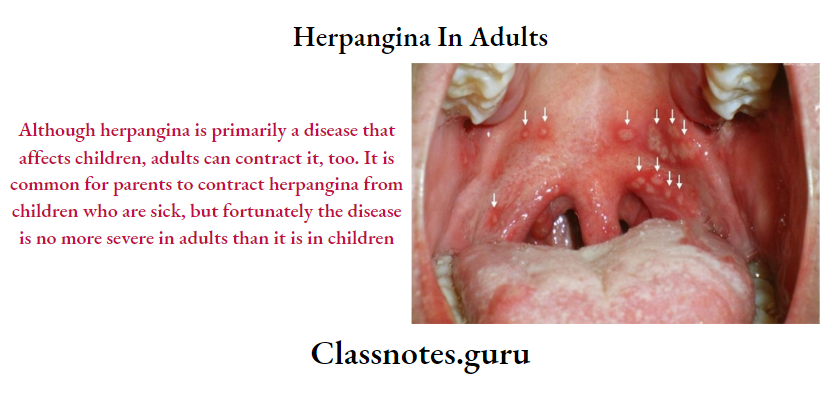 Herpangina In Adults