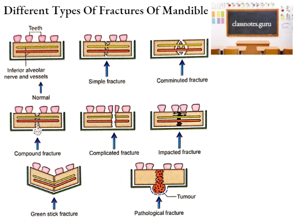 Mandible Different Types Of Fractures Of Mandible