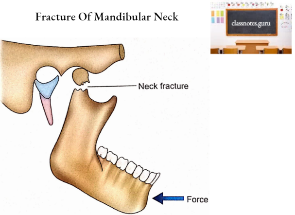 Mandible Fracture Of Mandibular Neck