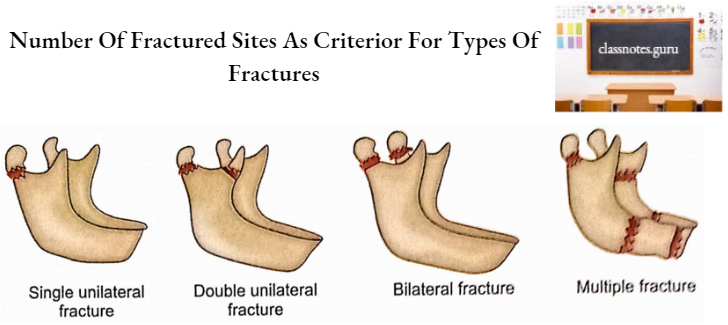 Mandible Number Of Fractured Sites As Criterior For Types Of Fractures