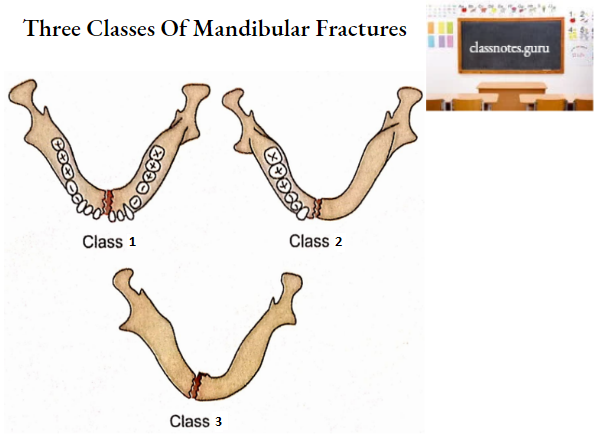Mandible Three Classes Of Mandibular Fractures