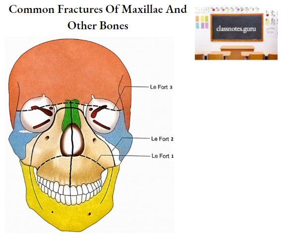 Maxillae Common Fractures Of Maxillae And Other Bones