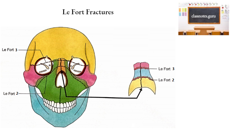 Nasal Bones Le Fort Fractures