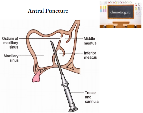 Nasal Cavity Antral Puncture
