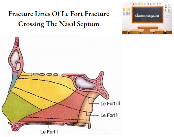 Nasal Cavity Fracture Lines Of Le Fort Fracture Crossing The Nasal Septum