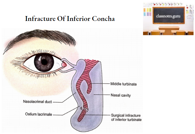 Nasal Cavity Infracture Of Inferior Concha
