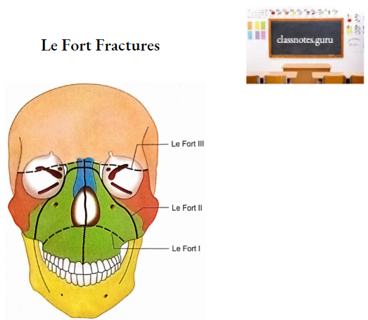 Oral Cavity Le Fort Fractures