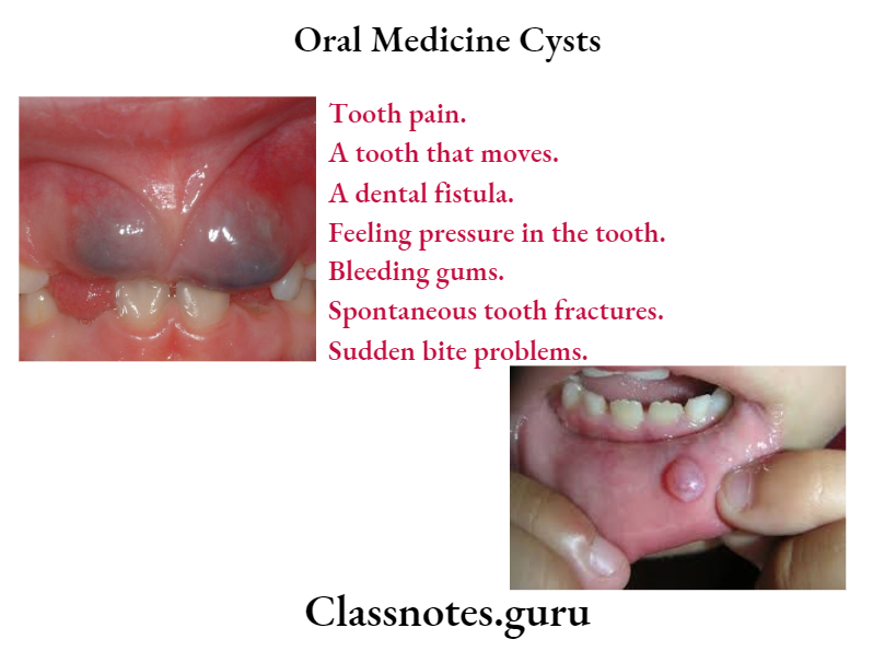 Oral Medicine Cysts