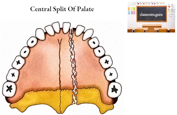 Palatine Bone Central Split Of Palate