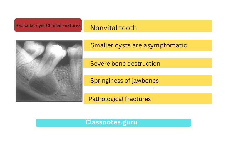 Radicular cyst Clinical Features