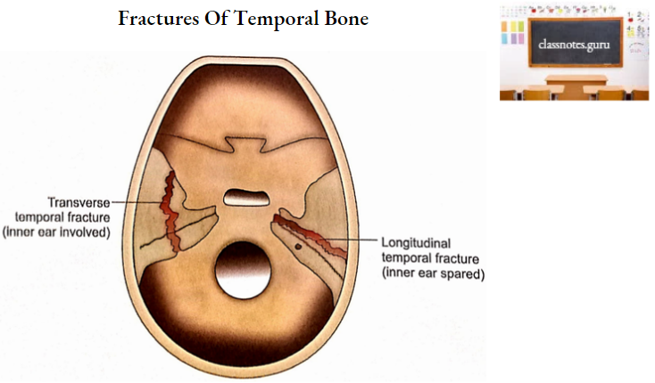 Temporal Bones Fractures Of Temporal Bone