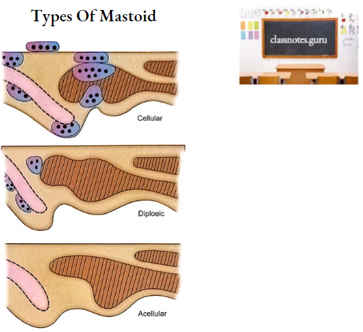 Temporal Bones Types Of Mastoid