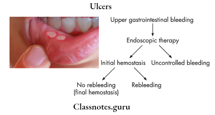 Ulcers Upper Gastrointestinal Bleeding