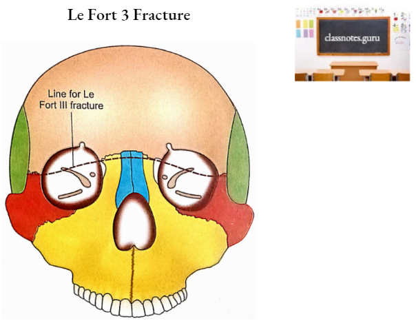 Zygomatic Bones Le Fort 3 Fracture
