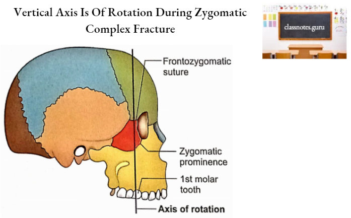Zygomatic Bones Vertical Axis Is Of Rotation During Zygomatic Complex Fracture