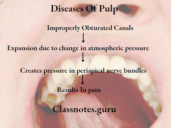 Endodontics Diseases Of Pulp Aerodontalgia Reason