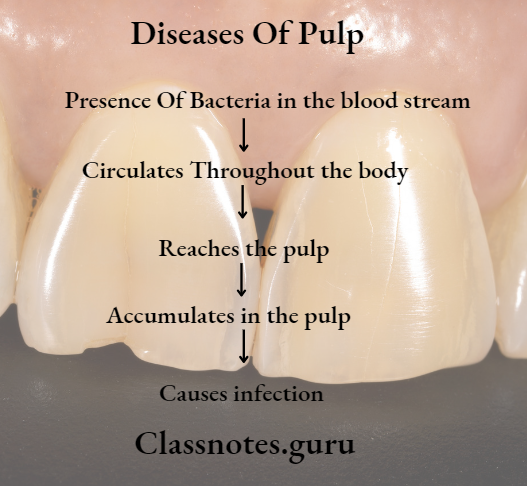 Endodontics Diseases Of Pulp Anachoresis