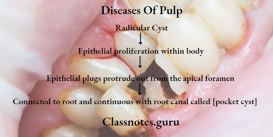 Endodontics Diseases Of Pulp Pocket Cyst Pathogenesis