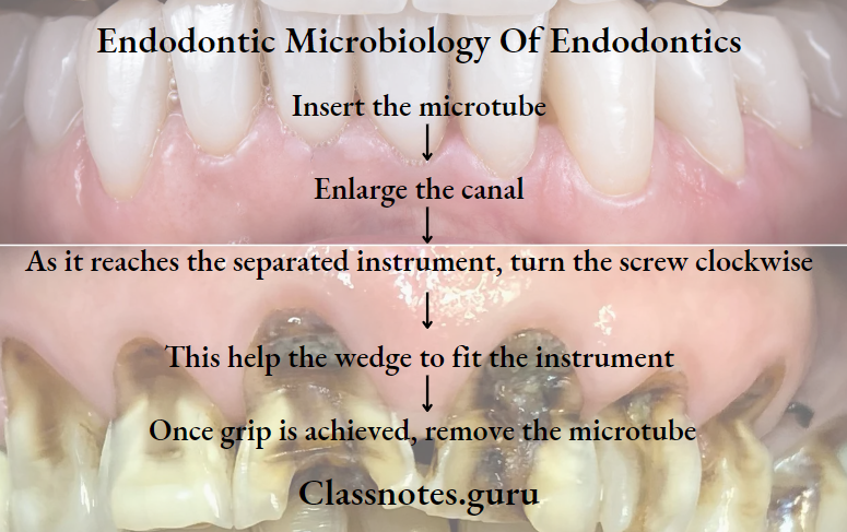Endodontics Miscellaneous Retrieval System