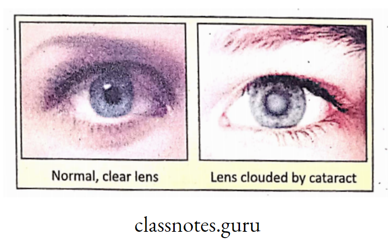 Normal lens and Cataract