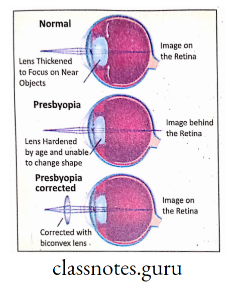Presbyopia