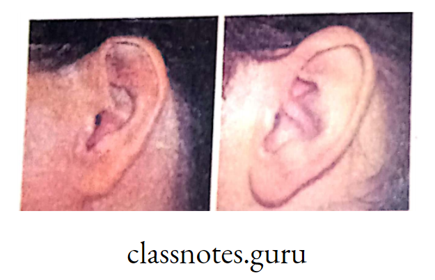 Ear lobe in man (Genetically Inherited)